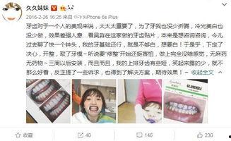 明星网红牙贴面,瞬间焕新笑容的秘密武器