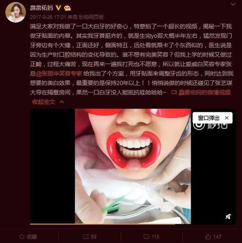 明星网红牙贴面,瞬间焕新笑容的秘密武器
